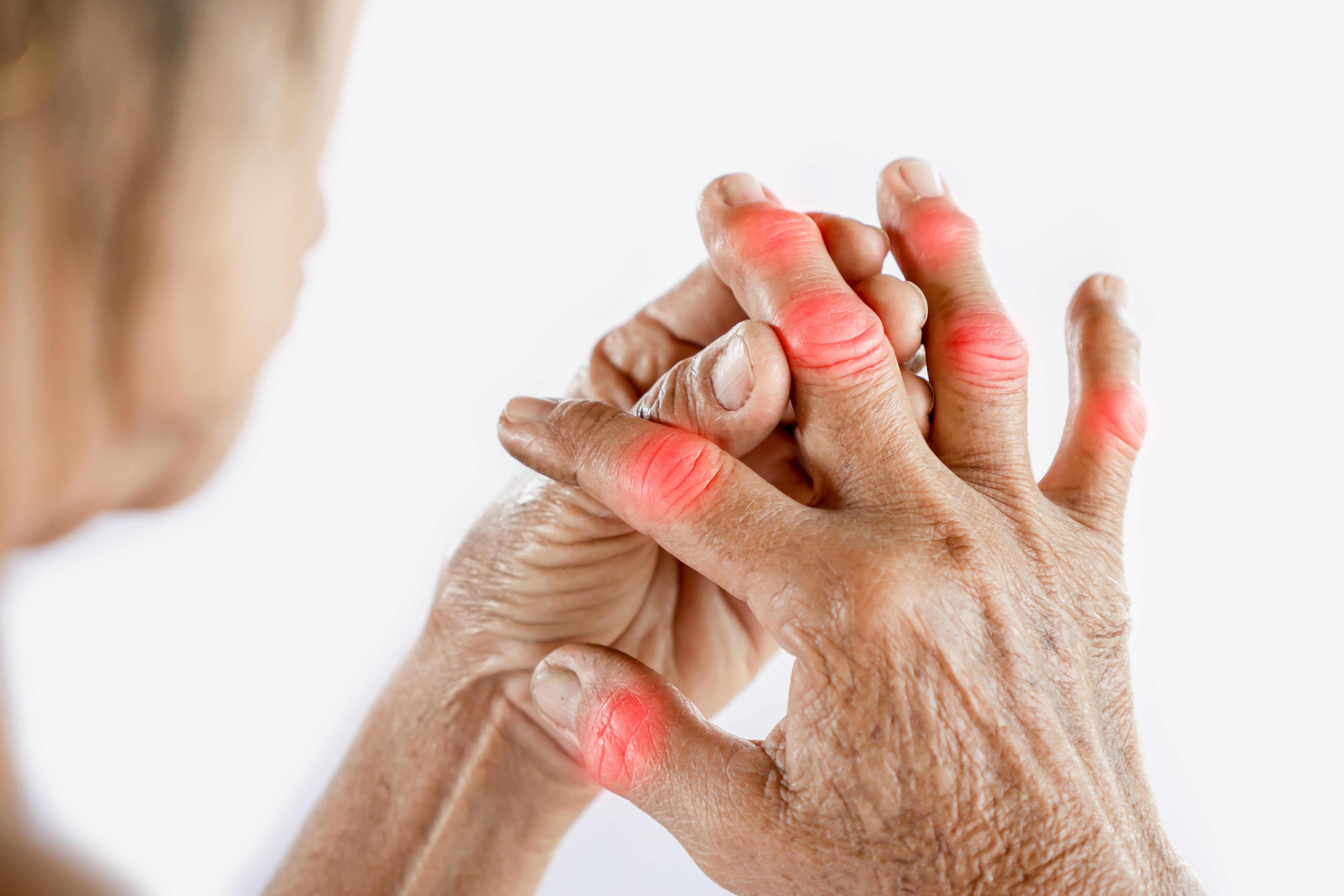 patient suffering from rheumatoid arthritis | Image Credit: doucefleur - stock.adobe.com