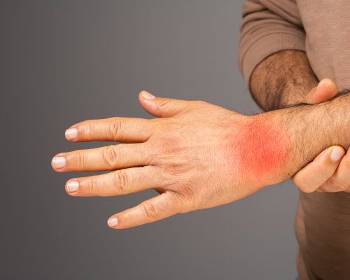 RA burden | Image credit: Skin and Cancer Institute
